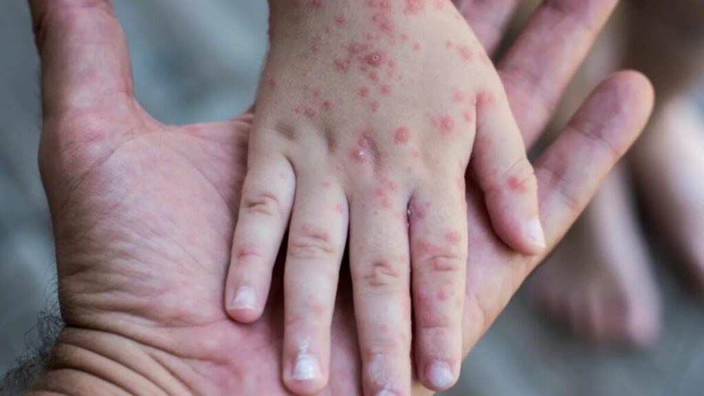 Personal de salud aplica vacuna triple viral en campaña preventiva contra el sarampión en Morelos.